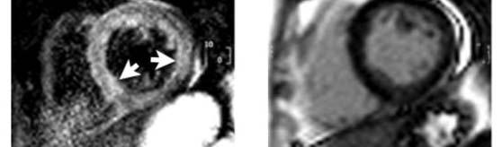 2011. Viability image (Necrosis) Myocardial Edema :