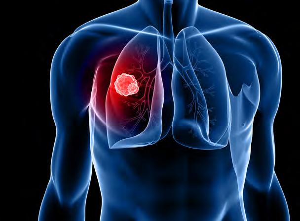 LUNG CANCER 2017: Progress and Future Directions November 4, 2017 Renaissance Dupont Circle Hotel FIRST NAME MIDDLE INITIAL LAST NAME SUFFIX DEGREE HOSPITAL / COMPANY / ORGANIZATION MEDICAL SPECIALTY