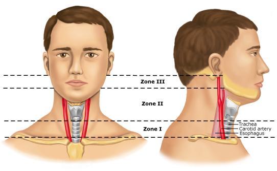 Anatomic Zones Used in PNI Zone I: extends from the sternal notch and clavicles to the cricoid cartilage.