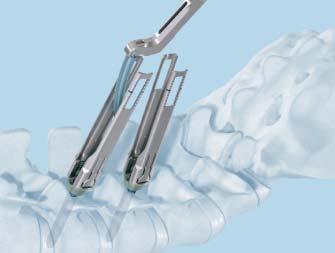Align the slots of the tissue retractors prior to rod insertion.