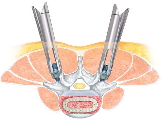 Supplemental Posterior Fixation Anterior fusion procedures MATRIX MIS provides posterior stabilization to augment an ALIF procedure where supplemental posterior instrumentation is desired.