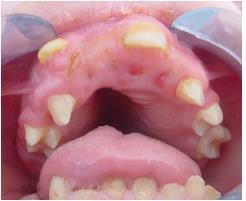 Mouth and Teeth Heart: valvular abnormalities; systemic hypertension Airways and Respiration Recurrent pulmonary infections Obstructive airway disease Enlarged