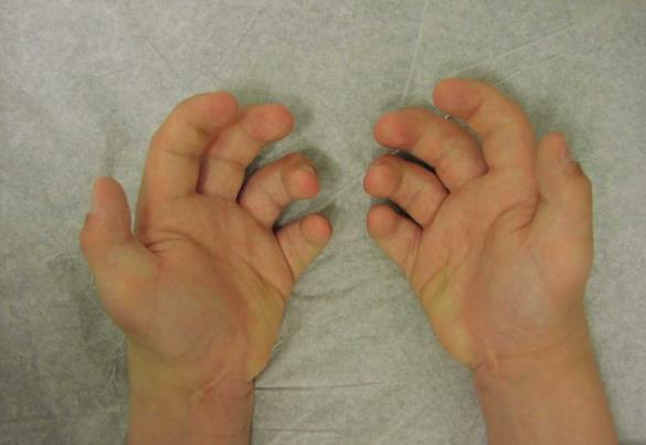 hand deformity Trigger