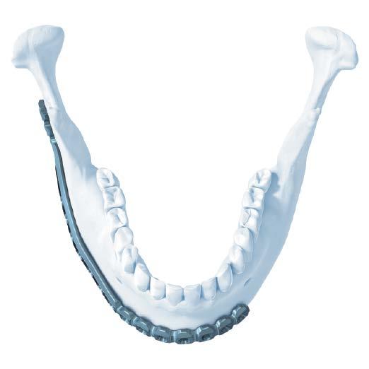 6 Position plate Instrument 03.503.062 MatrixMANDIBLE Plate Introducing Forceps Place the plate over the planned resection or fracture zone.