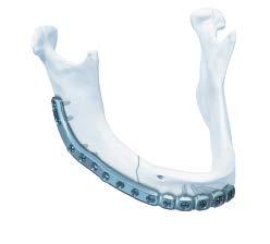 Indications The DePuy Synthes CMF MatrixMANDIBLE Preformed Reconstruction Plates are intended for use in oral and maxillofacial surgery, trauma, and reconstructive surgery.