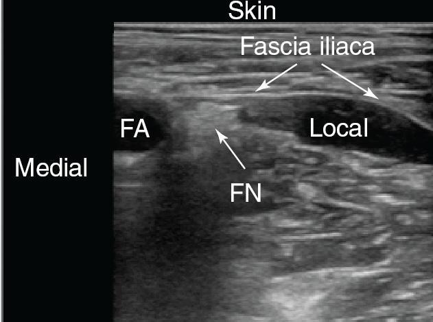 Fascia iliaca block: In plane transverse view Probe in transverse position just below inguinal ligament Iliopsoas muscle in centre of screen FA and nerve on
