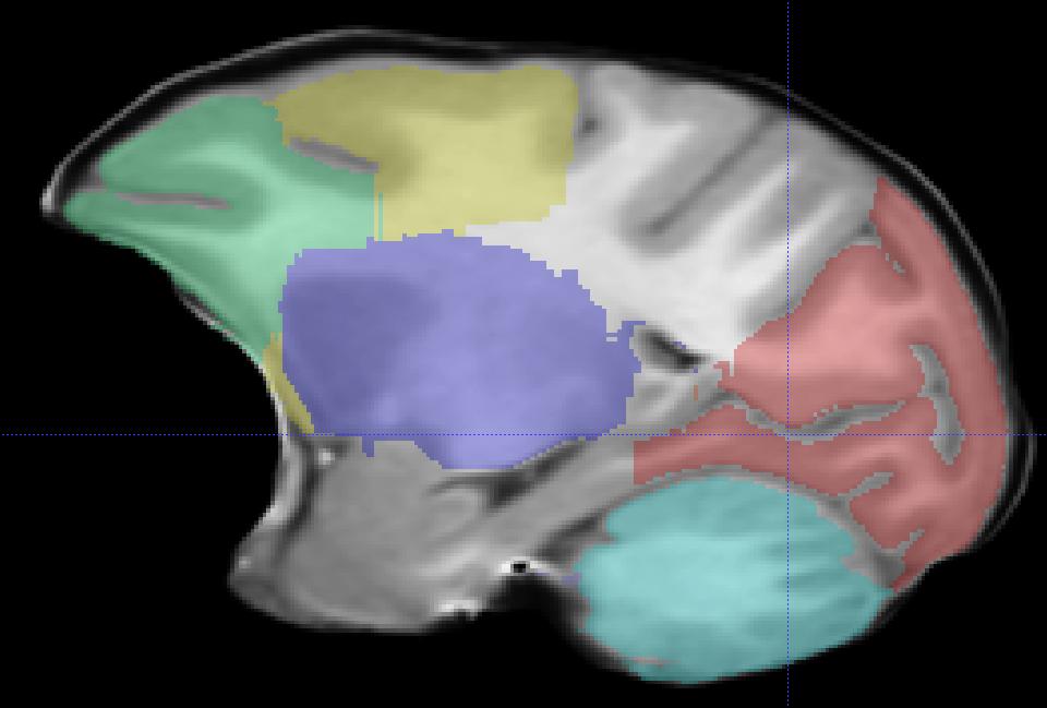 Tracing: A) Begin tracing the occipital lobe in the sagittal plane, working from medial to lateral.