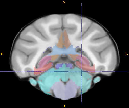 2) The posterior boundary is the occipital lobe 3) The anterior boundary is CSF on the most inferior slices and the subcortical trace on more superior slices.