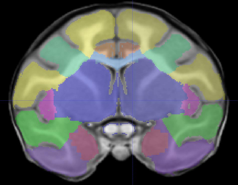 1) The superior boundary of the visual temporal lobe is the auditory temporal lobe trace in anterior slices.