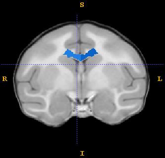 Anterior to the knee of the cingulate sulcus (where it emits the marginal ramus), the lateral boundary is traced as a straight line between the cingulate sulcus and the lateralsuperior corner of the