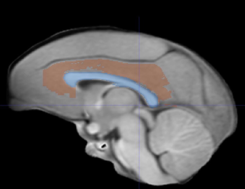 II. Cingulate Gyrus The cingulate gyrus is bounded at its anterior and superior extents by the cingulate sulcus, at its inferior extent by the callosal sulcus and corpus callosum, and at its medial