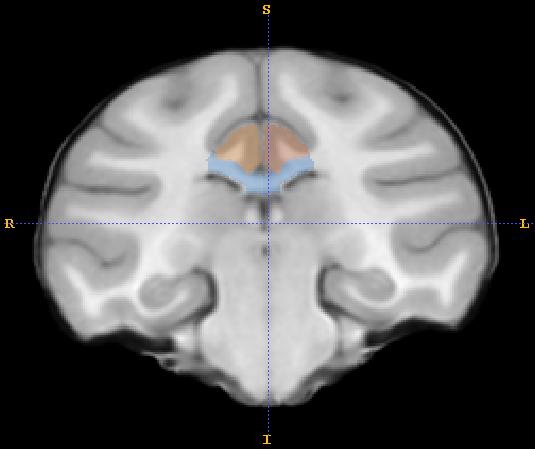 Anterior to the knee of the cingulate sulcus (where it emits the marginal ramus), the lateral boundary is traced as a straight line across the WM, connecting the depths of the cingulate and callosal