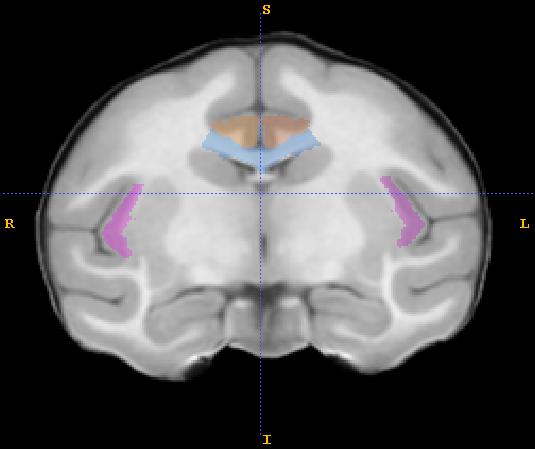 III. Insula The insula consists of the gray matter in the depth of the Sylvian Fissure.