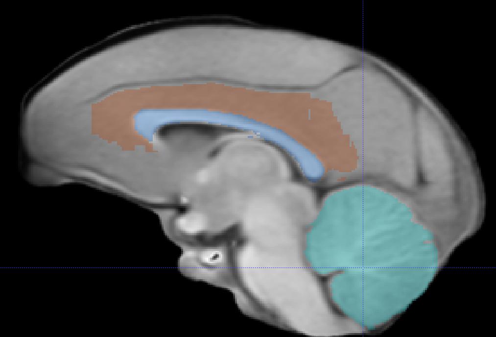 Tracing: A) The cerebellum is mostly traced in the sagittal view, working medial to lateral. 1) Begin at the cerebellum mid-sagittal slice.