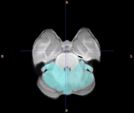 3) The anterior boundary at the level of the superior cerebellar peduncles is defined as the posterior extent of the pons. That is, slice the superior cerebellar peduncles flush with the pons.