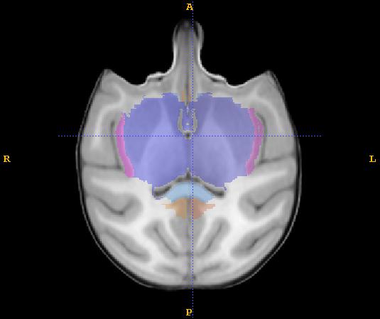 Tracing: A) The subcortical area is first identified and traced in the sagittal plane. Begin at the mid-sagittal slice and work medial to lateral. 1) The CC label is the superior boundary.