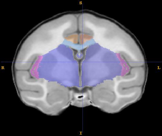 4) In more lateral slices, boundaries change slightly: a. The cerebellum trace defines the boundary with the cerebellar peduncles. b. The caudate nucleus defines the anterior boundary.