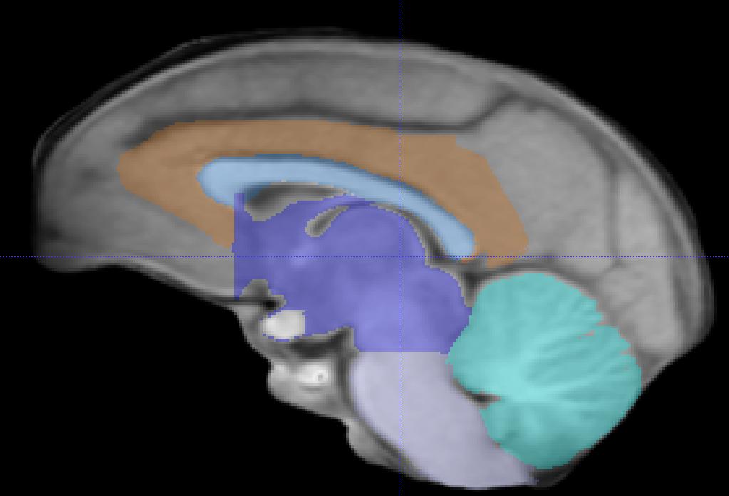 VI. Medulla and Pons (Brainstem) Major Boundaries: The superior boundary is the subcortical exclusion area trace; the anterior boundary is CSF; the posterior boundary is CSF or the cerebellar trace;