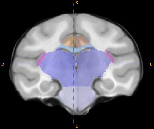 A) The medulla and pons are identified and traced in the sagittal view. Begin at the midsagittal slice and work medial to lateral.