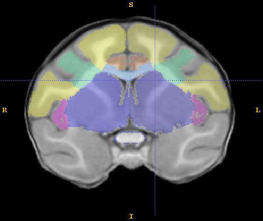 2) Use the axial view, working superior to inferior, to mark the lateral portion of the central sulcus throughout the frontal lobe. b.