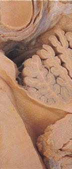Beneath the corpus callosum in an accurately hemisected brain is a membrane called the septum pellucidum.