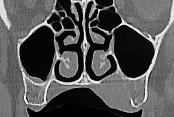 Figure 19: Polymorphous low grade adenocarcinoma of palate suited to unilateral inferior maxillectomy with resection crossing midline and including the base of the nasal septum Figure 21: Coronal CT