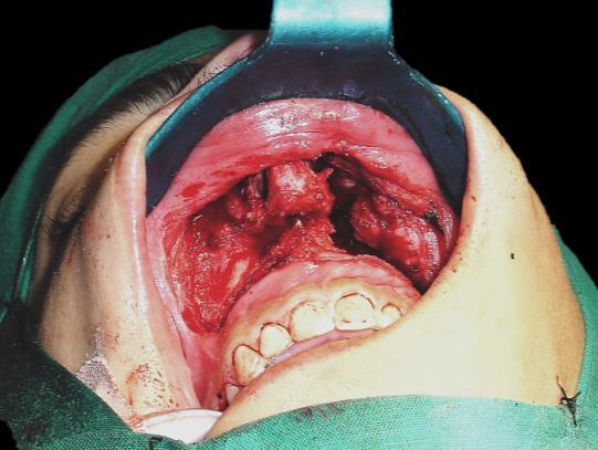 Figure 22: Midfacial degloving approach Local anaesthetic with vasoconstrictor is injected along the planned mucosal or skin incisions The sublabial mucosa is incised along the gingivobuccal sulcus