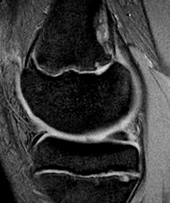 MRI of the Knee: Part 4 - normal variants that may