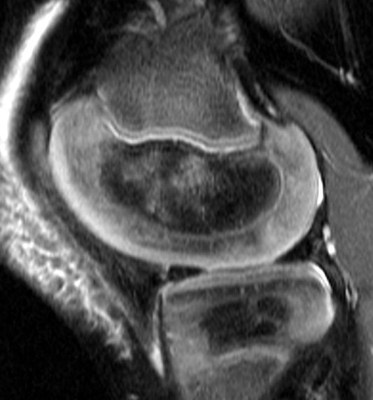 Epiphyseal Cartilage: signal intensity Age related changes 24 6 yr old female Early (< 1 yr) homogeneous Wgt-bearing (1-3
