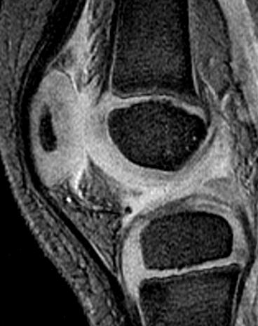 Bones: Bipartite patella Patellar ossification primary