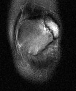 Bones: bipartite patella Symptomatic acute / chronic trauma MRI fracture / avulsion may be overlooked as etiology