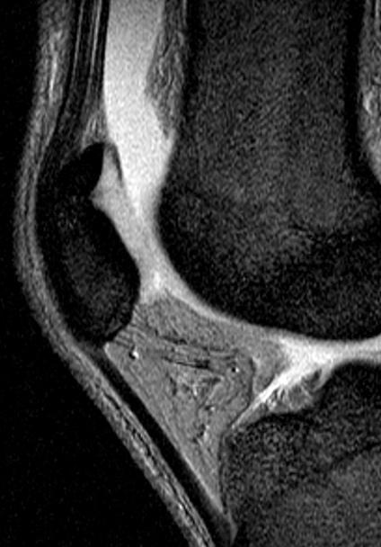 Bones: dorsal defect of the patella Unknown etiology Incidence 0.