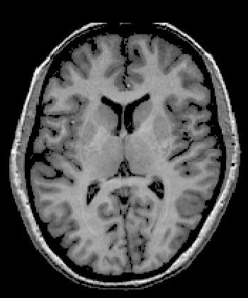 temporal lobe from