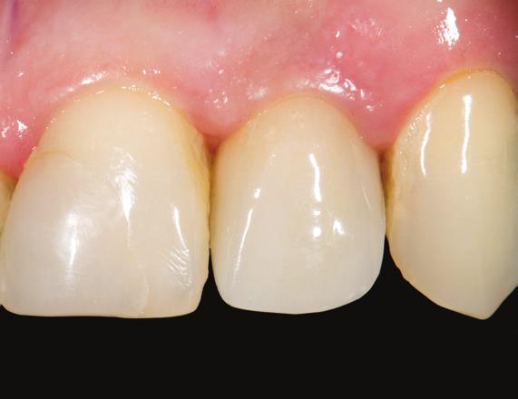 abutment and zirconia based crown.