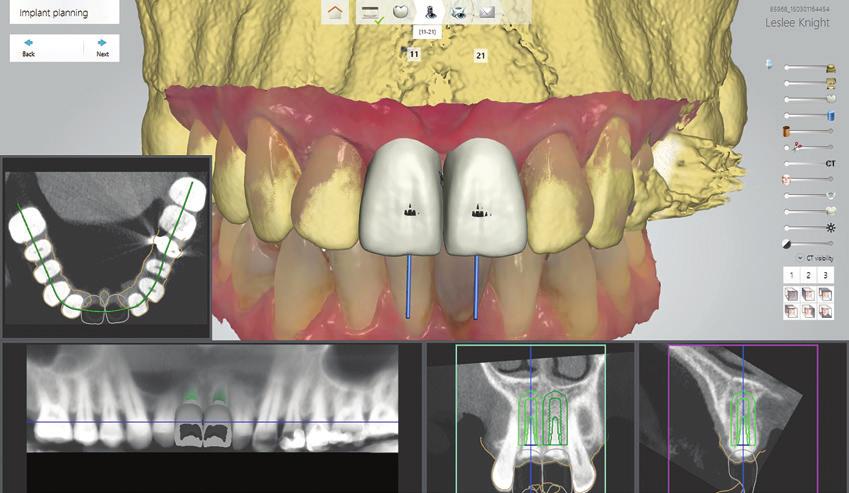 Only once the bone graft has healed was the a TRIOS scan obtained along with the CBCT.