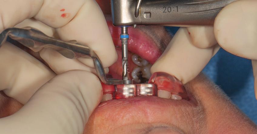 The plan showed that narrow implants were required to each of the 11 and 21 sites