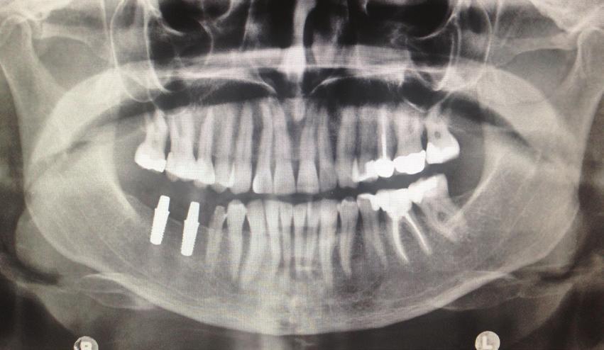 Final implant placement can be seen on the OPG showing