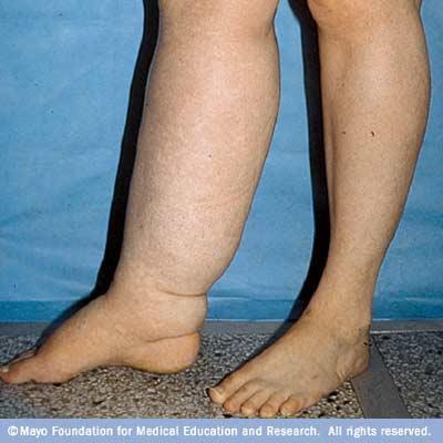 Lymphedema - Blockage in lymphatic system causing swelling in affected arm or leg - Causes: surgery, radiation treatment,