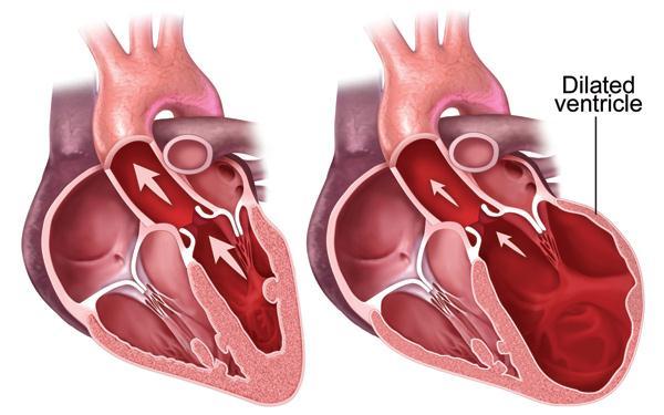 PVC s Cardiac Causes