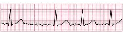 Atrial Fibrillation Significance of AF is related to: Cause Persistence Ventricular rate Presence of symptoms SOB/DOE, angina, fatigue,