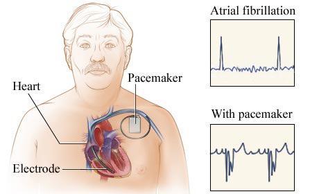 requiring permanent pacemaker AF may still be present, but pacemaker governs