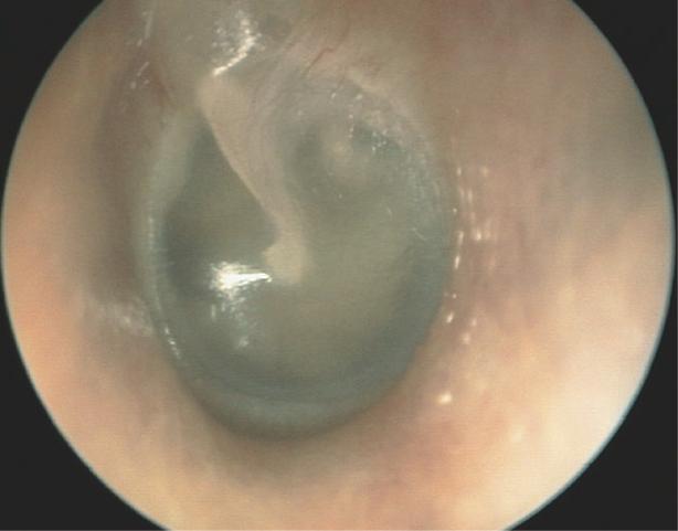 Chapter 1 The ear: some applied basic science Pars flaccida Handle of malleus Light reflex Pars tensa Figure 1.1 The normal tympanic membrane (left).