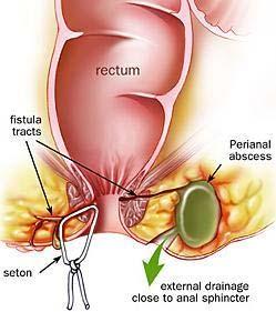 Perianal abscess/fistula-in-ano Usually arise from the anal glands that lie in or near