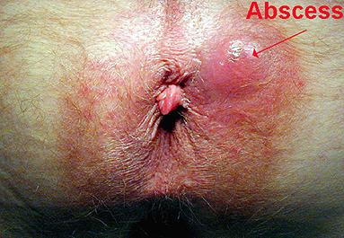 drainage 50% may have a fistula-inano after the abscess has been drained surgically or