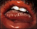 Leukoplakia Oral Thrush (yeast