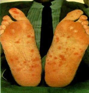 Syphilis Rash caused by Syphilis Type: Bacterial Occurrence: Over 150,000 new cases a year in the