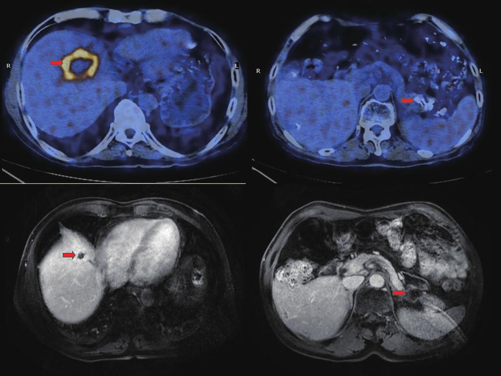 502 Wang et al. Comprehensive treatment of pancreatic neuroendocrine tumor A B C D Figure 1 Imaging evaluation of the primary and metastatic lesions before and after treatment.