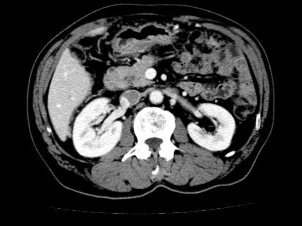The intrahepatic multiple masses varied in size