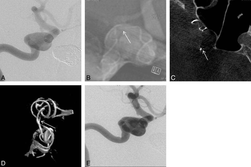 FIG 1. Right internal carotid artery digital subtraction angiography (A) revealed a 13-mm wide-neck cavernous segment aneurysm.