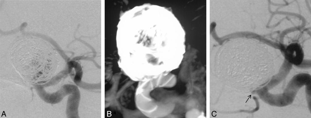 FIG 2. Right internal carotid artery digital subtraction angiography and 3D reconstruction (A C) reveal a giant cavernous segment aneurysm of approximately 25.3 mm.